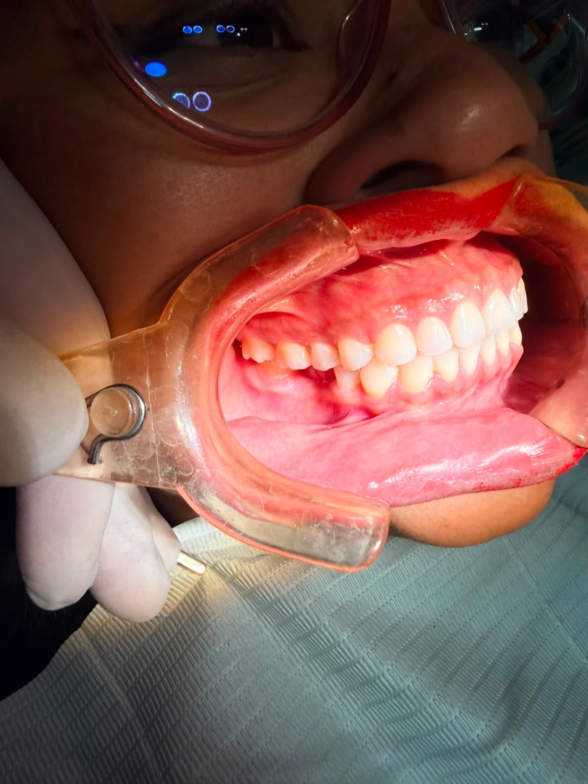 Extracción dental atraumática en consultorio